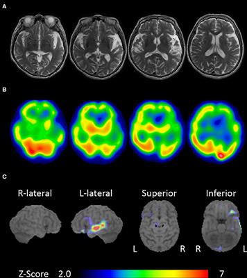 Non-fluent/Agrammatic Variant of Primary Progressive Aphasia With Generalized Auditory Agnosia